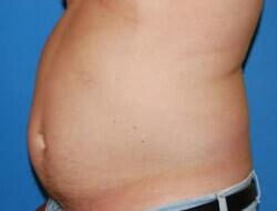 Liposuction Before & After Image