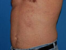 Liposuction Before & After Image