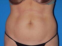 Liposuction Before & After Image