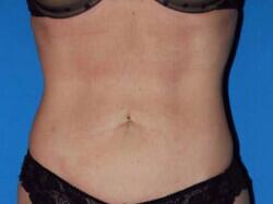 Liposuction Before & After Image