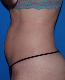 Liposuction Before & After Image