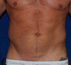 Liposuction Before & After Image