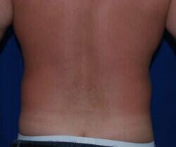 Liposuction Before & After Image