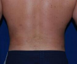 Liposuction Before & After Image