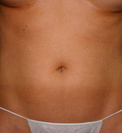 Liposuction Before & After Image