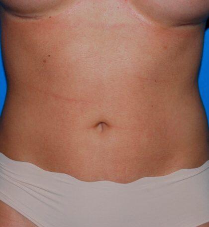 Liposuction Before & After Image