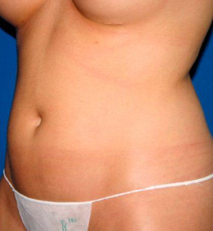 Liposuction Before & After Image