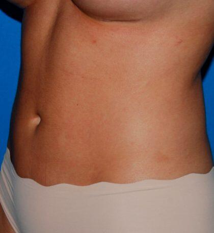 Liposuction Before & After Image