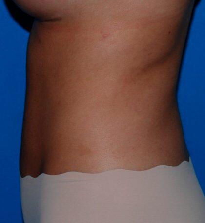 Liposuction Before & After Image