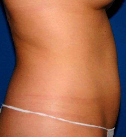 Liposuction Before & After Image