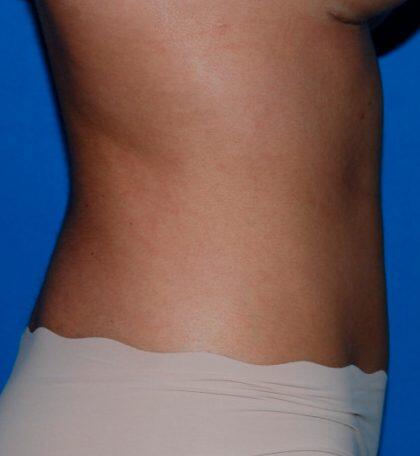 Liposuction Before & After Image