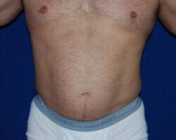 Liposuction Before & After Image