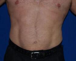 Liposuction Before & After Image