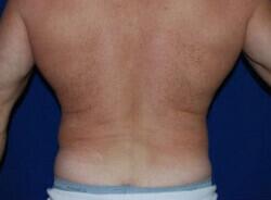 Liposuction Before & After Image