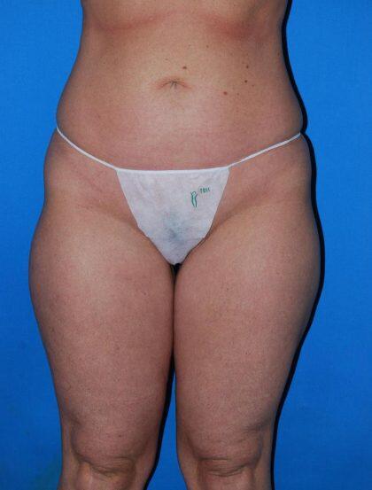 Liposuction Before & After Image