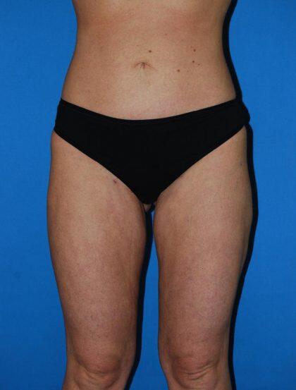 Liposuction Before & After Image