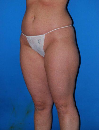 Liposuction Before & After Image