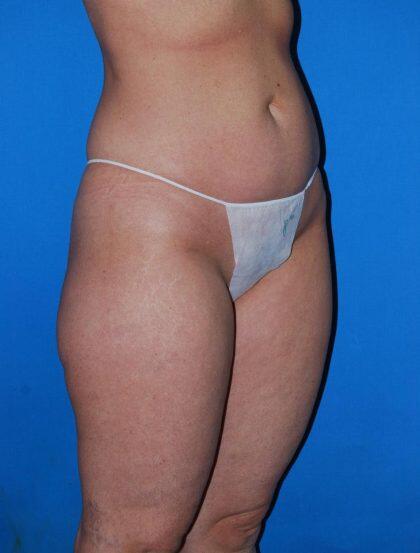 Liposuction Before & After Image