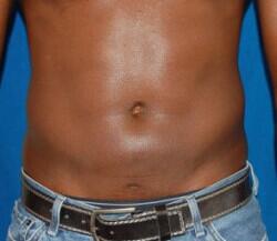 Liposuction Before & After Image