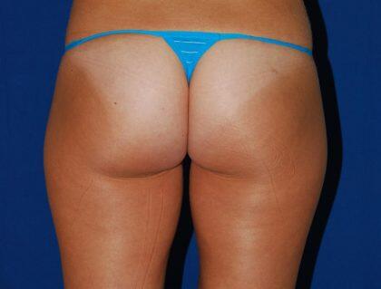 Liposuction Before & After Image