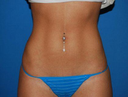Liposuction Before & After Image