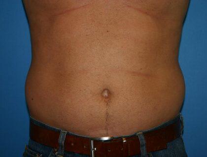 Liposuction Before & After Image