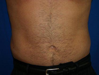 Liposuction Before & After Image