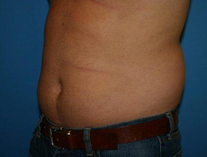 Liposuction Before & After Image