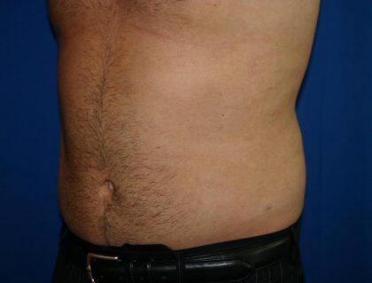 Liposuction Before & After Image