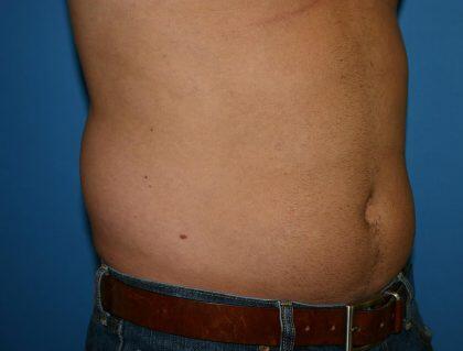 Liposuction Before & After Image