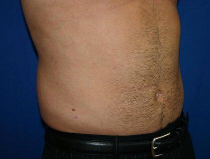 Liposuction Before & After Image