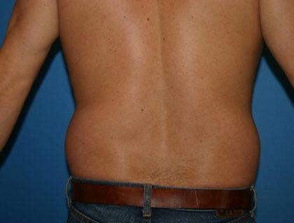 Liposuction Before & After Image