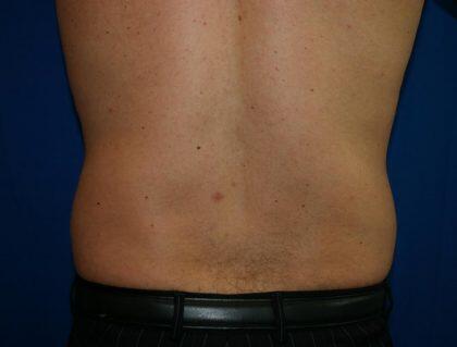 Liposuction Before & After Image
