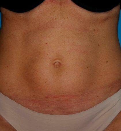 Liposuction Before & After Image