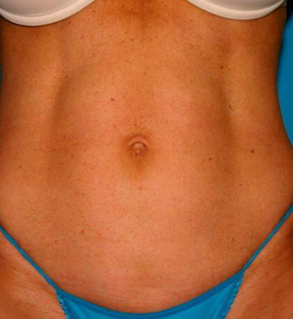 Liposuction Before & After Image