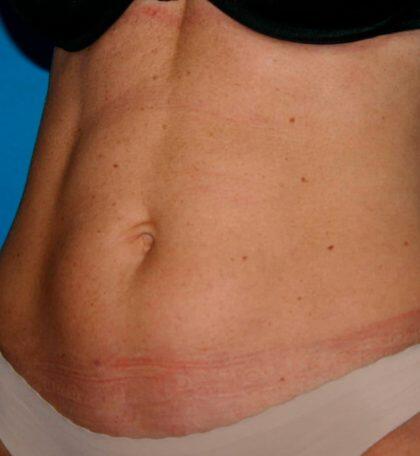 Liposuction Before & After Image