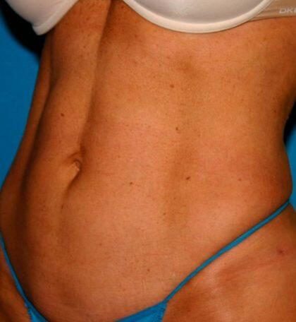 Liposuction Before & After Image