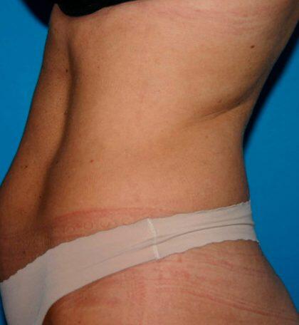 Liposuction Before & After Image