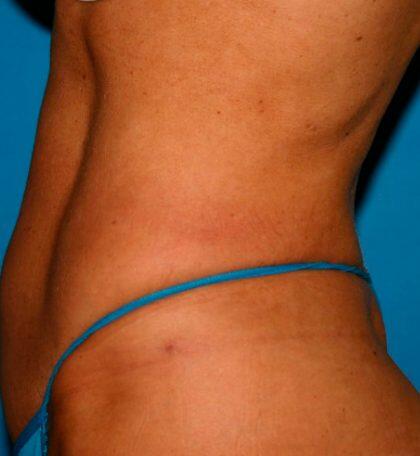 Liposuction Before & After Image