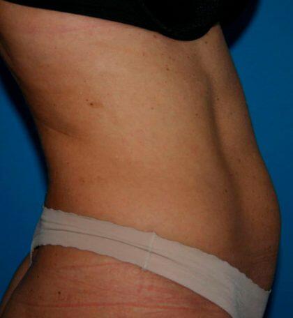Liposuction Before & After Image