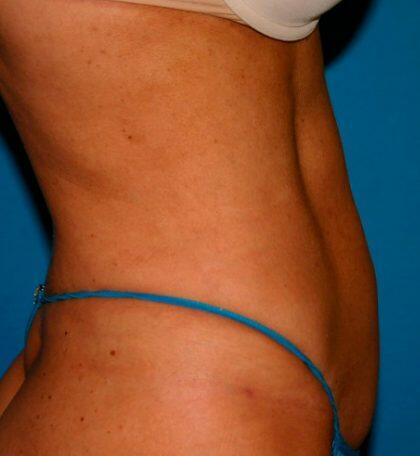Liposuction Before & After Image