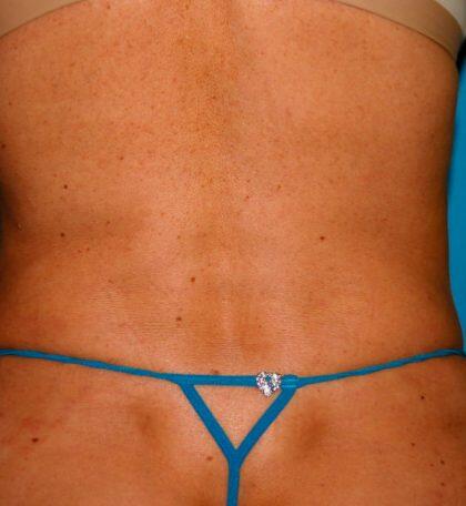 Liposuction Before & After Image