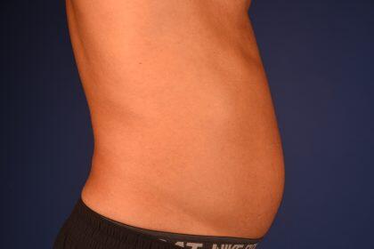 Liposuction Before & After Image