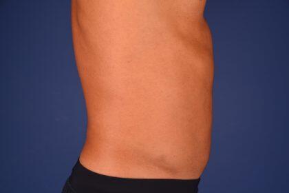 Liposuction Before & After Image