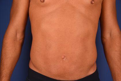 Liposuction Before & After Image