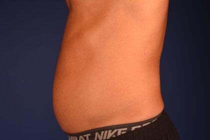 Liposuction Before & After Image