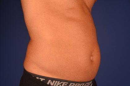 Liposuction Before & After Image