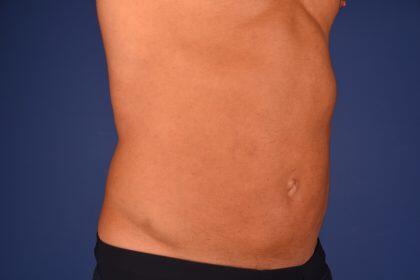 Liposuction Before & After Image
