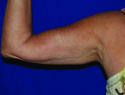 Minimal Incision Arm Lift Before & After Image