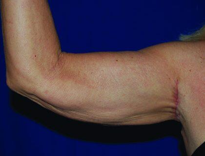 Minimal Incision Arm Lift Before & After Image